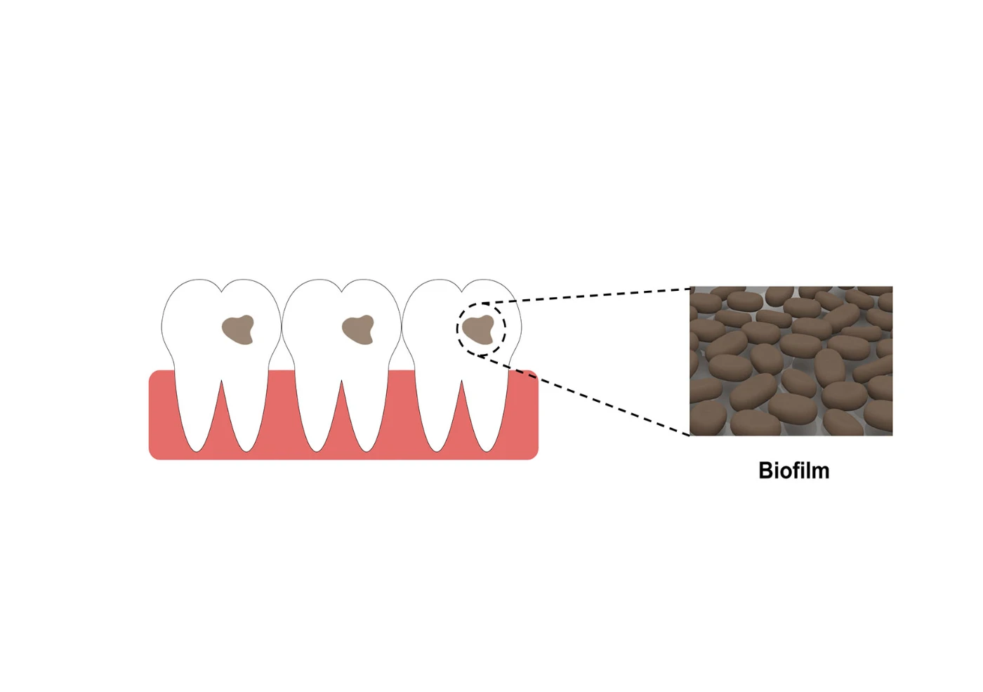 Biofilm formed by bacteria and fungi attaching to tooth surfaces