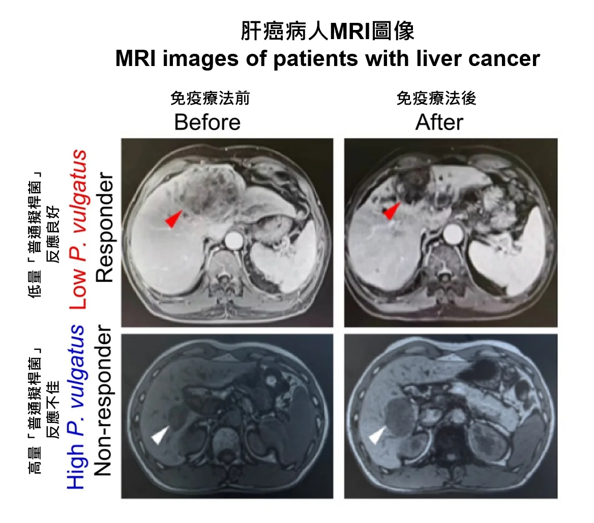港大醫學院發現腸道細菌「叛徒」導致肝癌免疫治療失效<br>
倡開發「腸道菌調控療法」提升療效