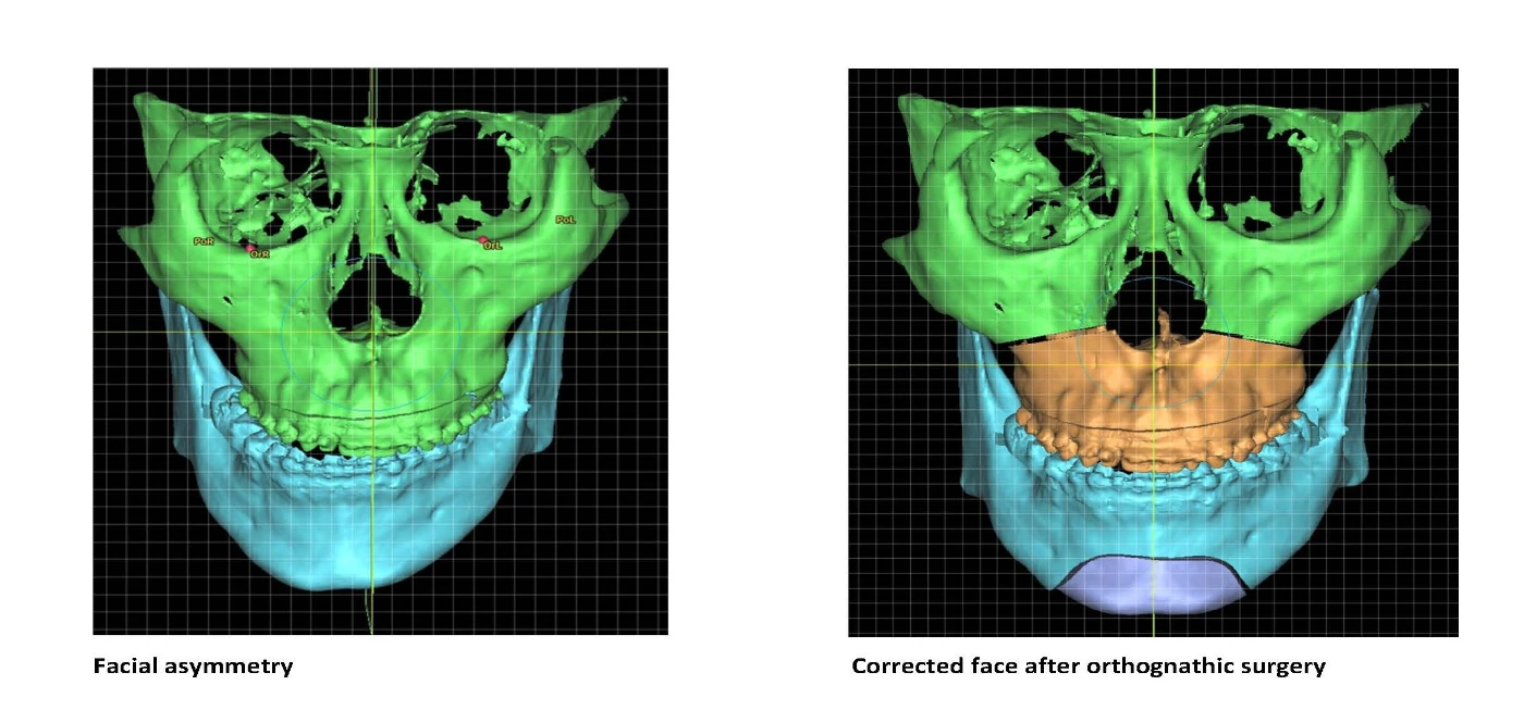HKU Dentistry study finds facial asymmetry correction surgery effective <br>
in relieving syndrome of jaw joint pain patients