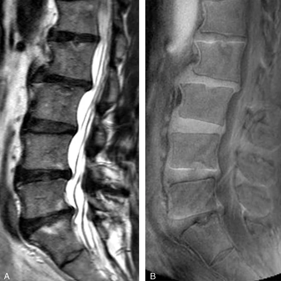 MRI of the lumbar spine of a subject with no chronic low back pain.