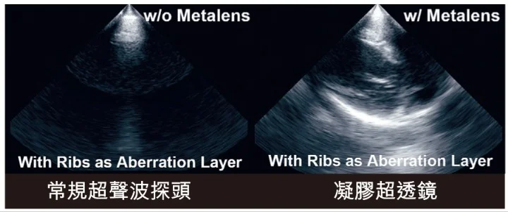 港大研發「動態控制超透鏡」　突破超聲波肋骨屏障　提升診療精準度
