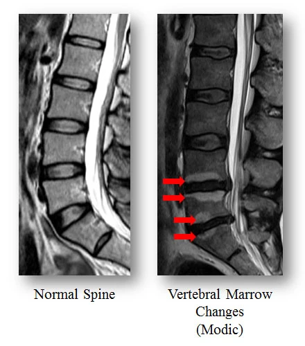 The left MRI photo shows the normal spine without Modic changes; Red arrows on the right photo show Modic changes in the spine.  Through different patterns and levels of Modic changes, low back pain development and severity can be diagnosed.
