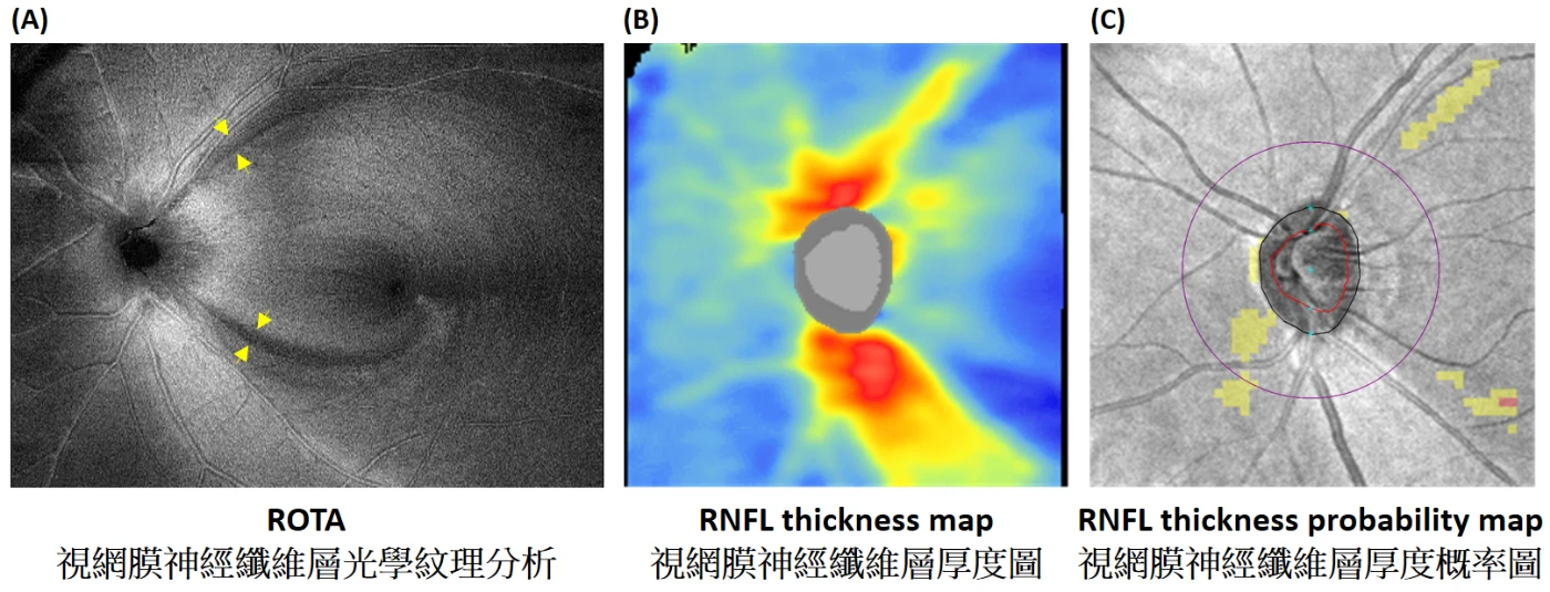 A new technology ROTA developed by HKUMed and CU Medicine can visualise axonal fibre bundles on the retina to advance early diagnosis of glaucoma and optic neuropathies