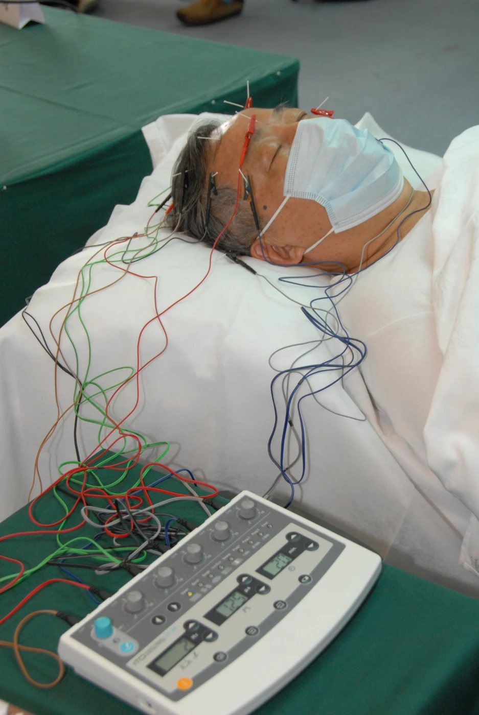 Mr NGAI is receiving dense cranial electroacupuncture stimulation.