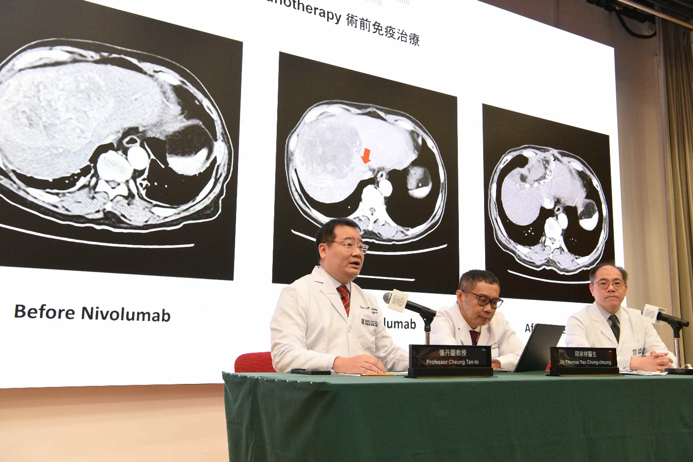 隨著「雙重免疫療法組合」效果顯著，新組合治療已獲得FDA、EMA和NMPA批准用於未接受過醫治的晚期肝癌。研究團隊包括（左起）張丹圖教授、邱宗祥醫生及梁澄宇醫生。