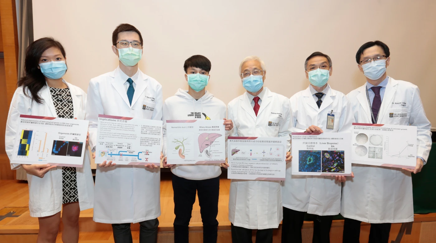 HKUMed discovered beta-amyloid deposition to be<br>
a novel disease mechanism for Biliary Atresia