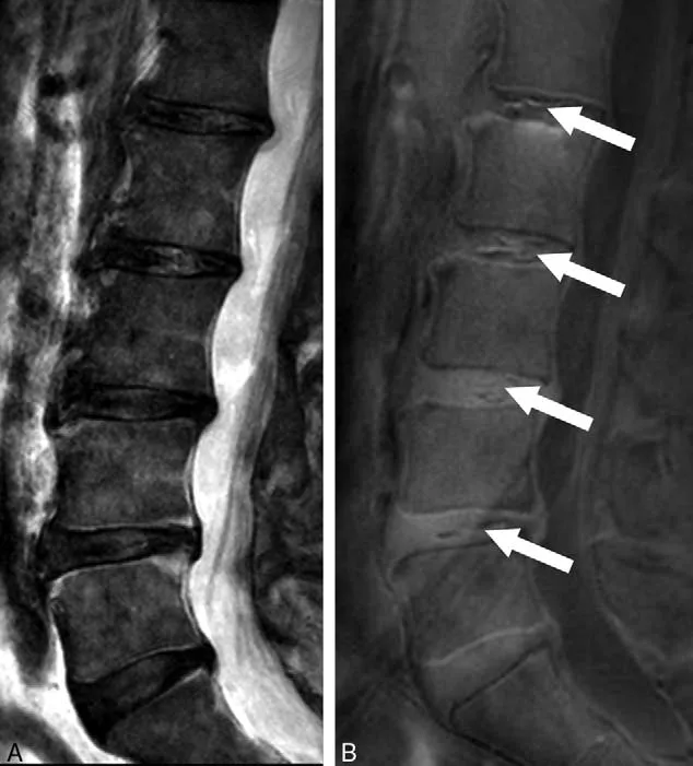 MRI of the lumbar spine of a subject with chronic low back pain and disability.