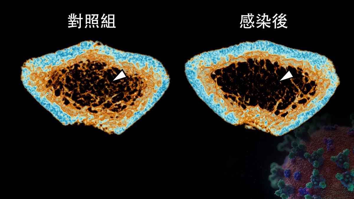 嚴重急性呼吸綜合症冠狀病毒2（SARS-CoV-2) 感染可導致新冠肺炎患者在急性期及康復後期出現炎性骨質流失。三維微米級計算機斷層成像技術重建顯示，感染新冠病毒的倉鼠（圖右）在股骨的小梁骨（白色箭頭）密度明顯低於未感染病毒的對照組（圖左）。